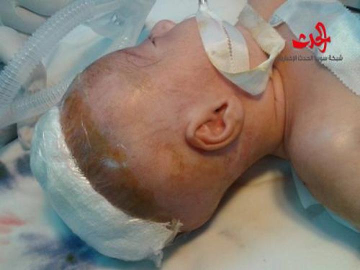 بالصور نجاح عملية جراحية لطفلة ولدت برأس إضافي