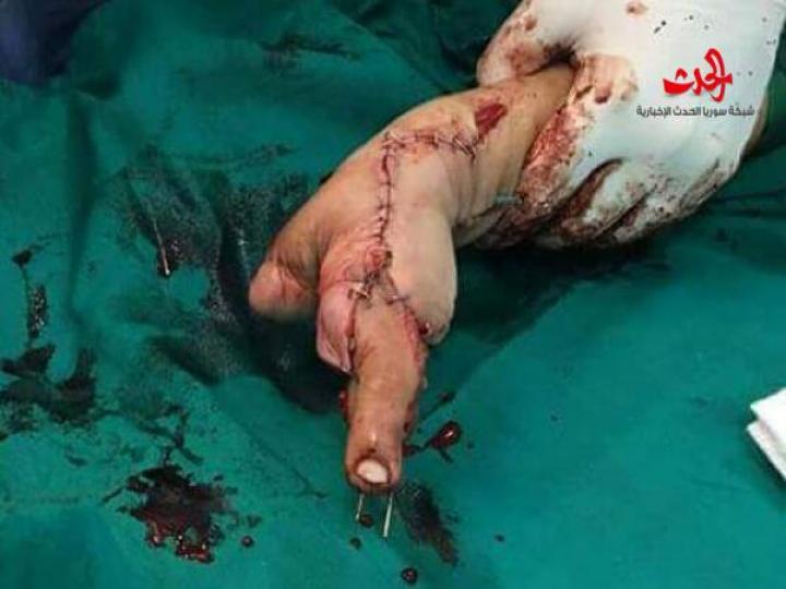 لأول مرة في سورية عملية نقل اصبع القدم الثانية لتعويض إبهام اليد بمشفى المواساة 