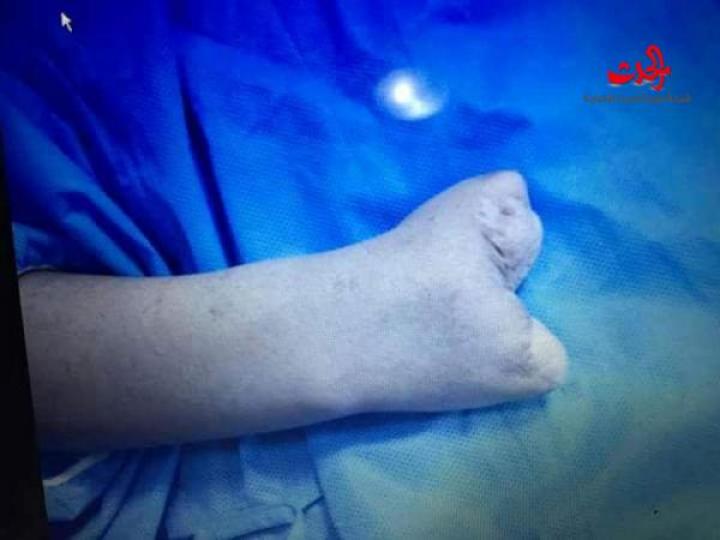لأول مرة في سورية عملية نقل اصبع القدم الثانية لتعويض إبهام اليد بمشفى المواساة 