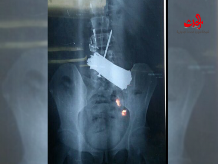 طبيب مصري يستخرج 39 مسمارا وقصافة أظافر من معدة مريض