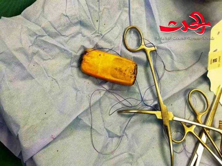 رجل مصري يحتفظ بهاتف محمول في معدته لمدة نصف عام