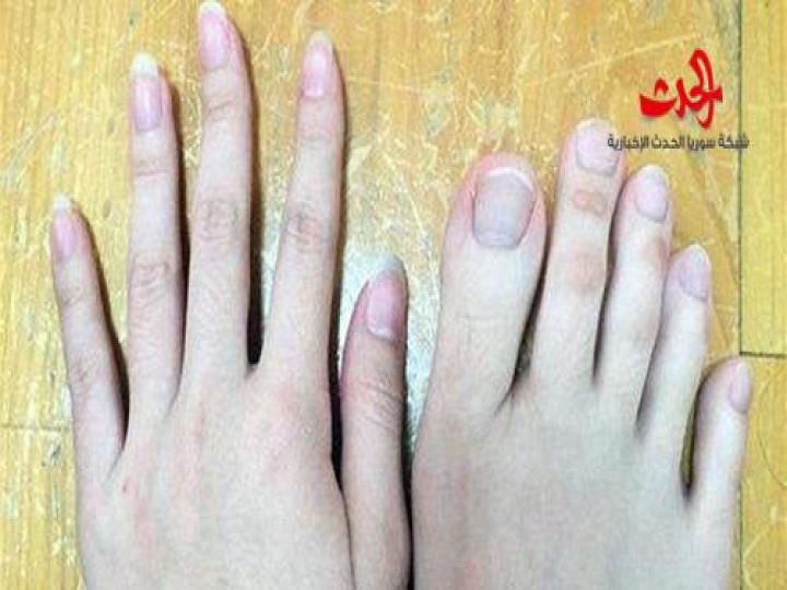 لن تصدقوا.. هذه أصابع قدمين أم يدين؟