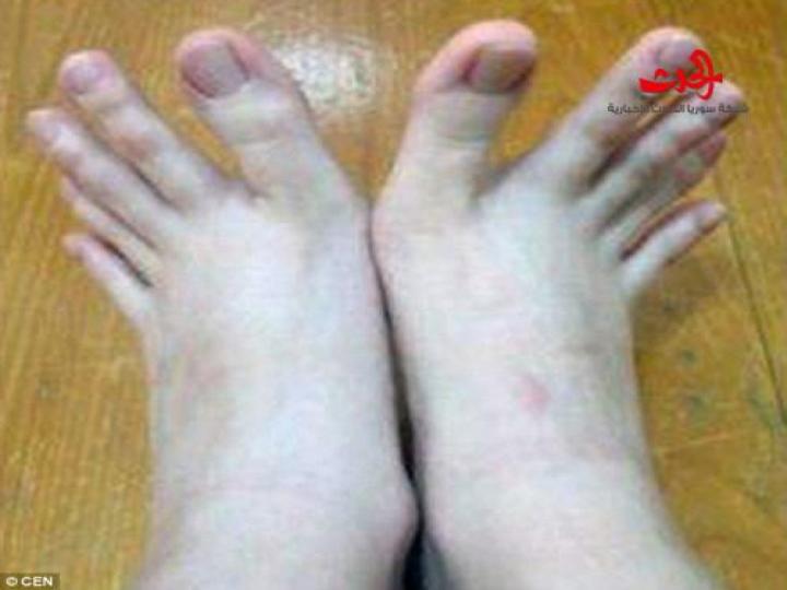 لن تصدقوا.. هذه أصابع قدمين أم يدين؟