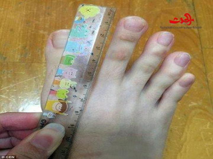 لن تصدقوا.. هذه أصابع قدمين أم يدين؟