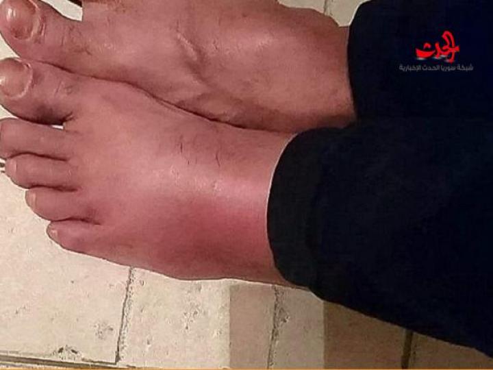 وفاة بطل كمال أجسام...بسبب خنفساء صور 