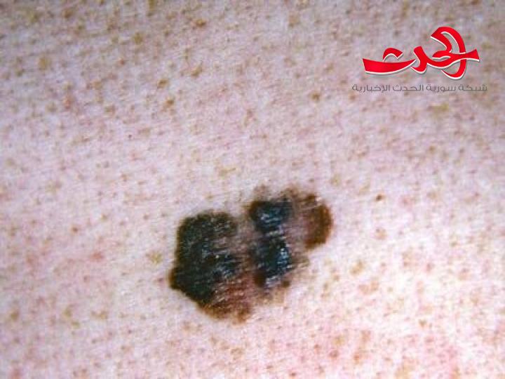أولى علامات السرطان تظهر على الجلد