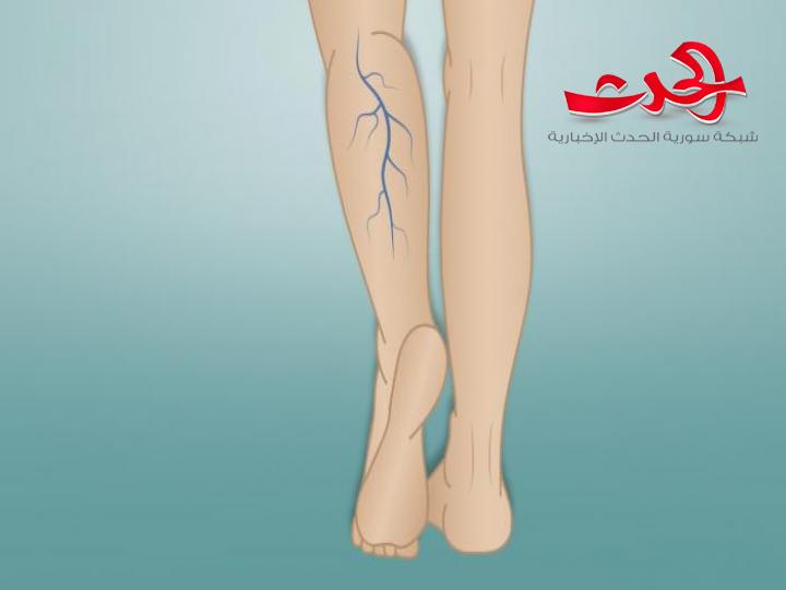 علامات ظهور دوالي الساقين Varicose veins... العلاج النهائي لمدة شهر كامل