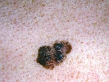 أولى علامات السرطان تظهر على الجلد