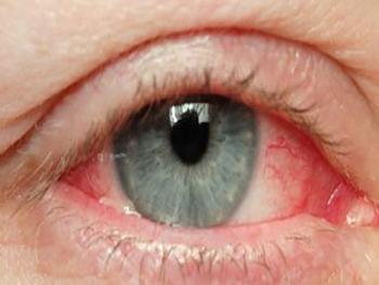 التهاب الملتحمة..فيروس كورونا في العين