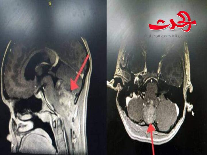 عمل جراحي دقيق ينقذ فتاة من أذية عصبية بمشفى الباسل بطرطروس